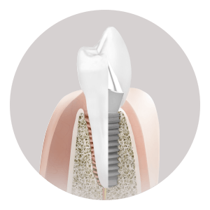 Die Geschichte vom Zahnimplantat